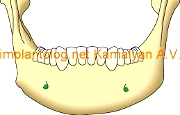 Имплантация зубов и форма номральной челюсти (без атрофиии костной ткани)